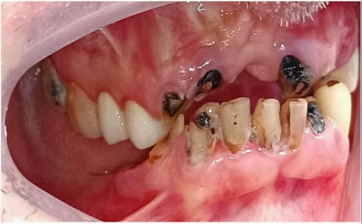 Clinical intraoral photograph demonstrating poor oral hygiene with generalized untreated dental disease, extensive caries, multiple grossly decayed teeth, retained root remnants, and heavy plaque accumulation. The image illustrates unfavourable patient factors including high caries risk, active disease, poor maintenance potential, and increased risk of restorative and endodontic treatment failure. Demonstrates how patient-related factors influence prognosis-driven treatment planning, where comprehensive disease control is required before considering tooth preservation and root canal treatment.