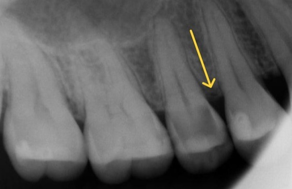 Periapical radiograph of a maxillary second premolar with deep caries extending to the pulp demonstrating intact periodontal support and preserved alveolar bone height. The image illustrates favourable periodontal conditions, a maintained crown-root ratio, and adequate supporting tissues despite pulpal involvement, supporting predictable long-term tooth retention following root canal treatment. Demonstrates periodontal assessment as a key prognostic factor favouring tooth preservation in evidence-based clinical decision making.
