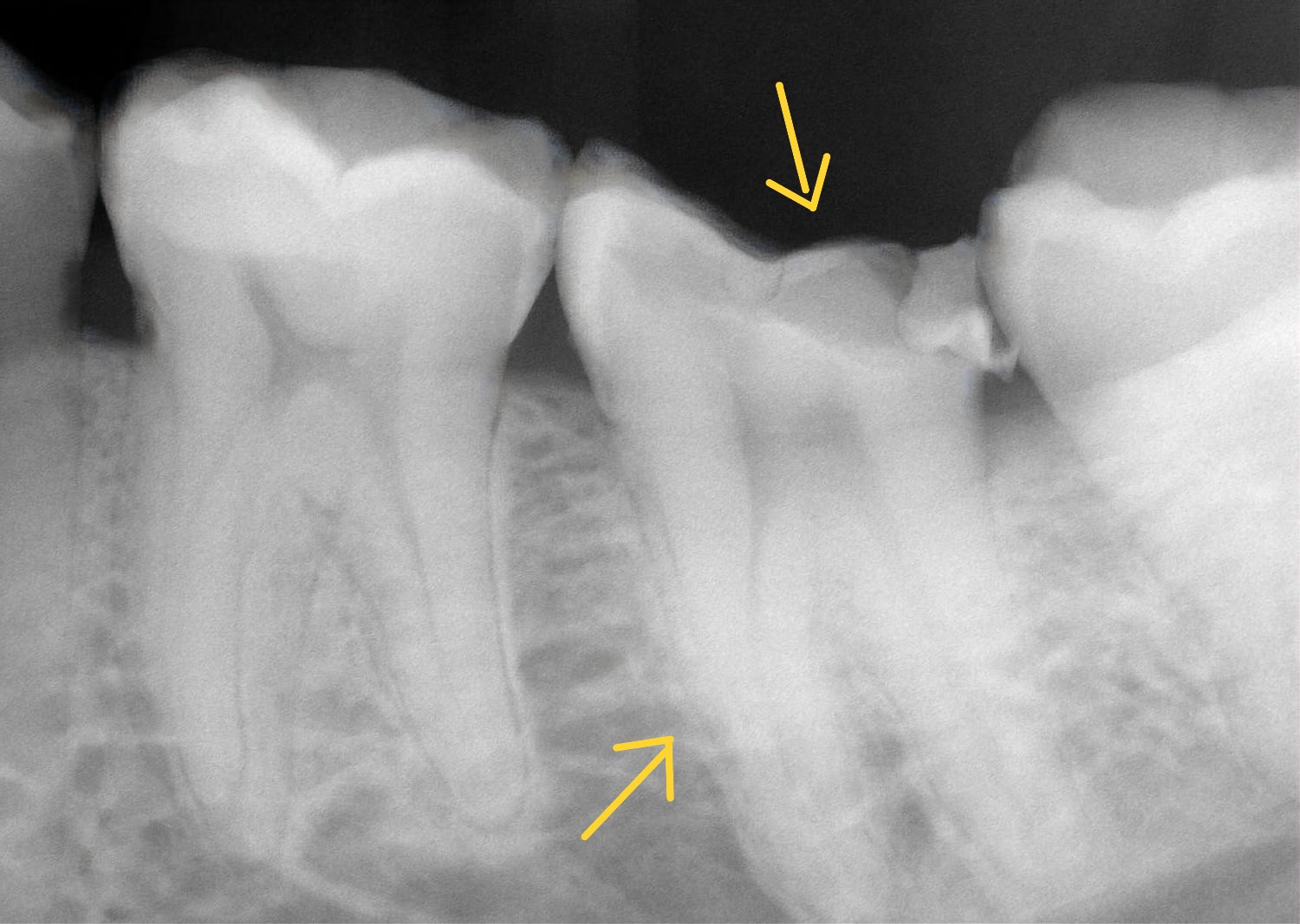 Periapical radiograph of a mandibular molar with deep coronal caries demonstrating adequate remaining coronal tooth structure and favourable restorability. The image illustrates a tooth with sufficient structural integrity and restorative foundation to support predictable root canal treatment followed by definitive coronal restoration. Demonstrates assessment of restorability as a key prognostic factor favouring long-term tooth preservation and evidence-based treatment planning.