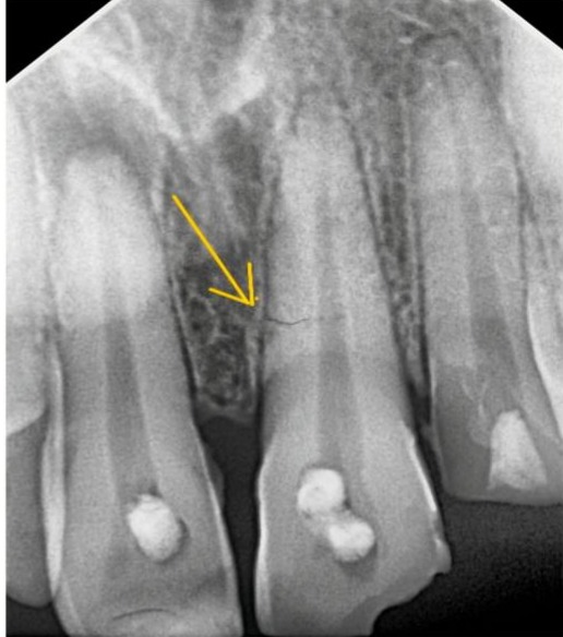 Periapical radiograph of a maxillary central incisor demonstrating an incomplete horizontal hairline fracture in the middle third of the root. The image illustrates a confined root fracture without features suggestive of vertical root fracture, preserving the potential for long-term tooth retention. Demonstrates fracture assessment as a key prognostic factor supporting tooth preservation, appropriate root canal treatment when indicated, and long-term clinical monitoring in evidence-based treatment planning.