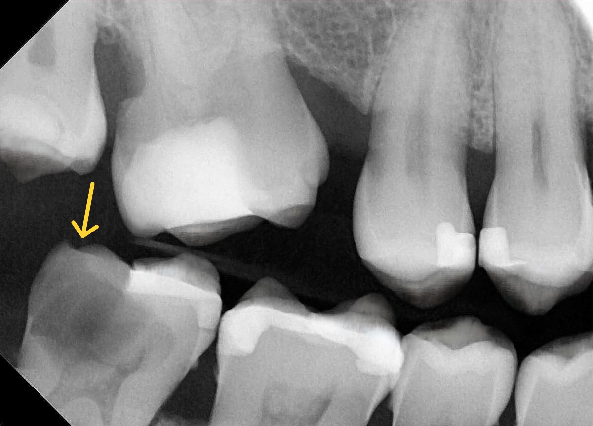 Bitewing radiograph of a deeply carious mandibular second molar with an intact opposing maxillary second molar, maintaining functional posterior occlusal support. Despite extensive coronal caries, the tooth retains strategic value because it contributes to mastication, posterior occlusion, and overall arch stability. Demonstrates strategic value assessment in prognosis-driven treatment planning, where preservation with root canal treatment may be favoured to maintain functional dentition and support long-term oral rehabilitation.