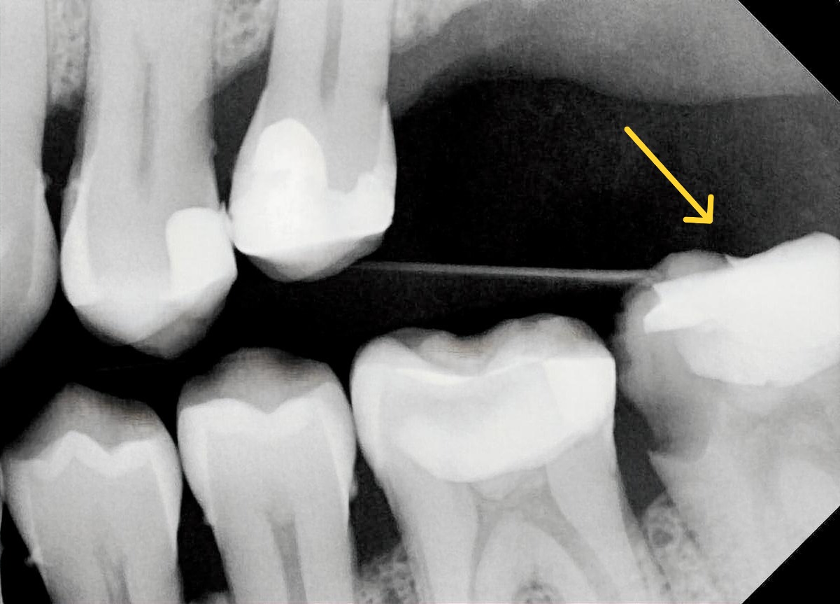 Bitewing radiograph of a deeply carious mandibular second molar with no functional opposing maxillary molar, demonstrating loss of posterior occlusal support and reduced strategic value. Despite being potentially restorable, the tooth has limited contribution to mastication, functional occlusion, and overall arch stability. Illustrates strategic value assessment in prognosis-driven treatment planning, where absence of an opposing tooth may lower the threshold for extraction when long-term prognosis is otherwise unfavourable.