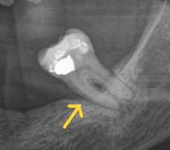 Periapical radiograph of a mandibular molar demonstrating advanced periodontal attachment loss with severe reduction of alveolar bone support. The image illustrates compromised periodontal support, an unfavourable crown-root ratio, and reduced long-term maintainability despite the tooth remaining present. Demonstrates periodontal assessment as a key prognostic factor favouring tooth extraction over root canal treatment when predictable long-term tooth retention is unlikely in evidence-based clinical decision making.