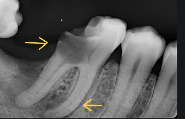 Periapical radiograph of a mandibular molar with extensive coronal destruction demonstrating inadequate remaining tooth structure and compromised restorability. The image illustrates severe structural loss with an unfavourable restorative foundation, reducing the predictability of definitive coronal restoration following root canal treatment. Demonstrates assessment of poor restorability as a key prognostic factor favouring tooth extraction over long-term preservation in evidence-based treatment planning.