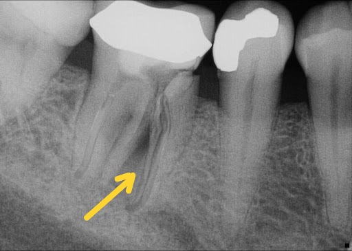 Periapical radiograph of a mandibular molar demonstrating a complete vertical root fracture involving the mesial root. The image illustrates a non-restorable fracture pattern with radicular extension, characteristic of vertical root fracture, resulting in poor structural prognosis and limited potential for long-term tooth retention. Demonstrates fracture assessment as a key prognostic factor favouring tooth extraction over root canal treatment in evidence-based clinical decision making.