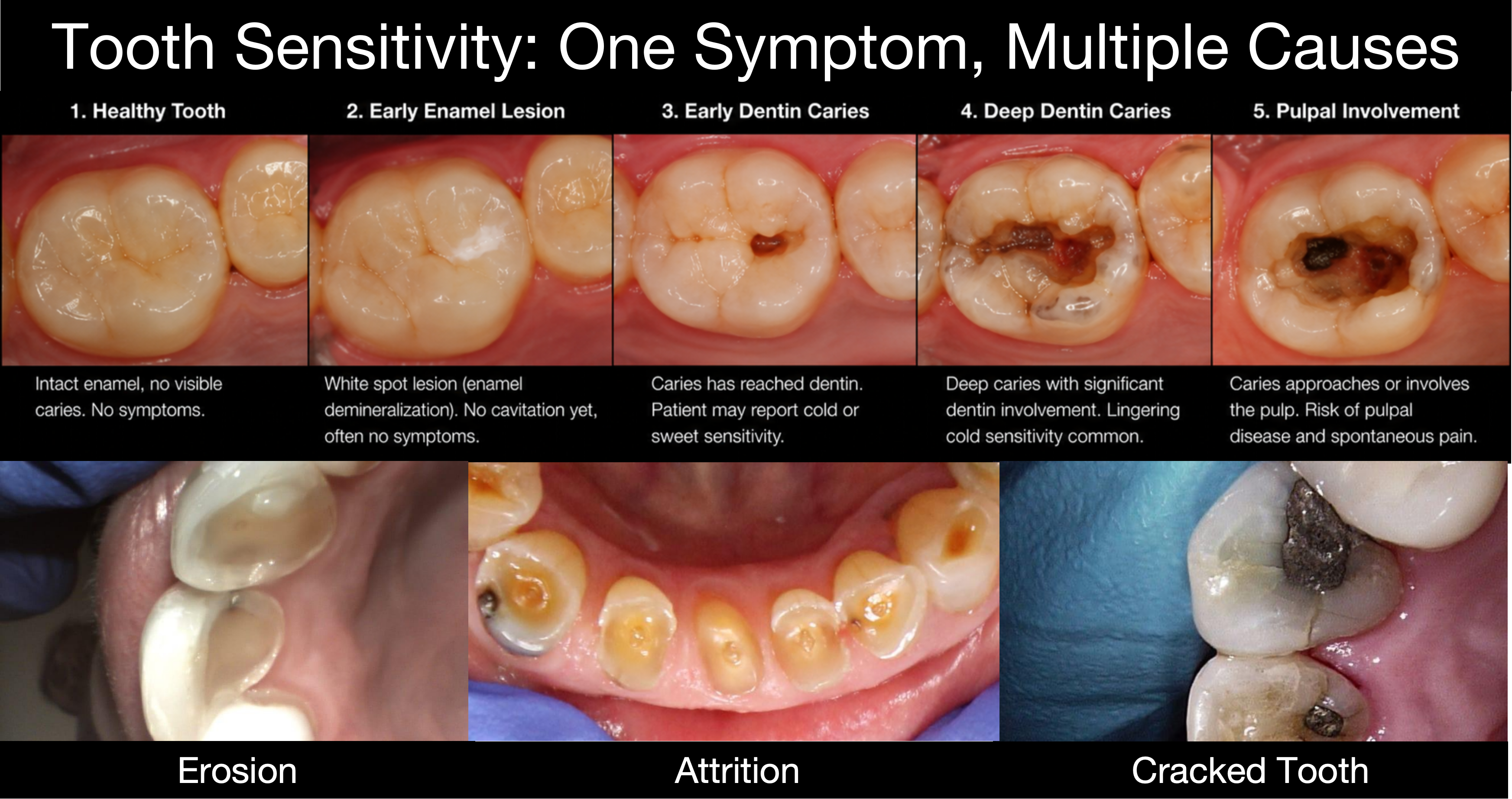 Composite showing the caries continuum from a healthy tooth through an early enamel lesion, early dentin caries, deep dentin caries, and pulpal involvement, alongside non-carious conditions including erosion, attrition, and a cracked tooth.
