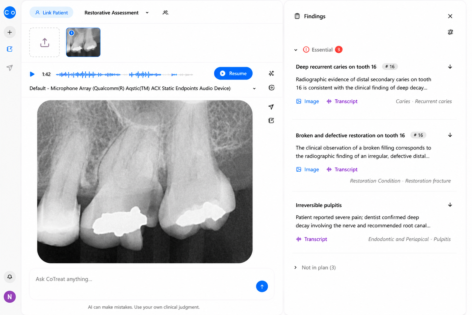 CoTreat Chairside interface displaying AI-generated structured clinical findings from integrated radiographic analysis and clinical conversation. The system automatically identifies deep recurrent caries, defective restoration, irreversible pulpitis, and associated diagnostic evidence while linking each finding to the supporting radiograph and clinical transcript. Demonstrates multimodal evidence integration, structured dental diagnosis, clinical documentation, and AI-assisted treatment planning for restorative and endodontic care.