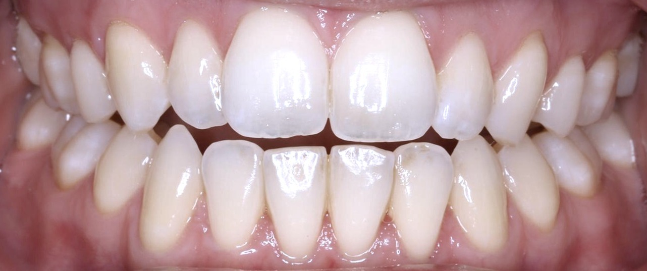 Clinical intraoral photograph demonstrating excellent oral hygiene with healthy gingival tissues, minimal plaque accumulation, and a low overall burden of oral disease. The image illustrates favourable patient factors for long-term dental treatment, including good plaque control, healthy periodontal tissues, and a maintainable oral environment. Demonstrates how patient-related factors support prognosis-driven treatment planning and improve the long-term success of root canal treatment, restorative dentistry, and tooth preservation.