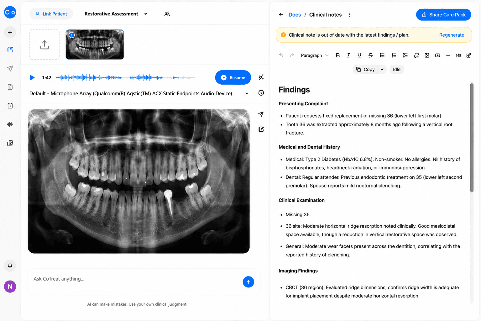 CoTreat Chairside clinical note interface showing an AI-generated Findings document for an implant consultation, recording the presenting complaint of a missing lower left first molar, Type 2 diabetes and non-smoker medical history, previous endodontic treatment on an adjacent tooth, moderate horizontal ridge resorption noted clinically, and CBCT imaging findings confirming adequate ridge width for implant placement. Demonstrates AI-assisted structured clinical documentation for implant candidacy assessment.