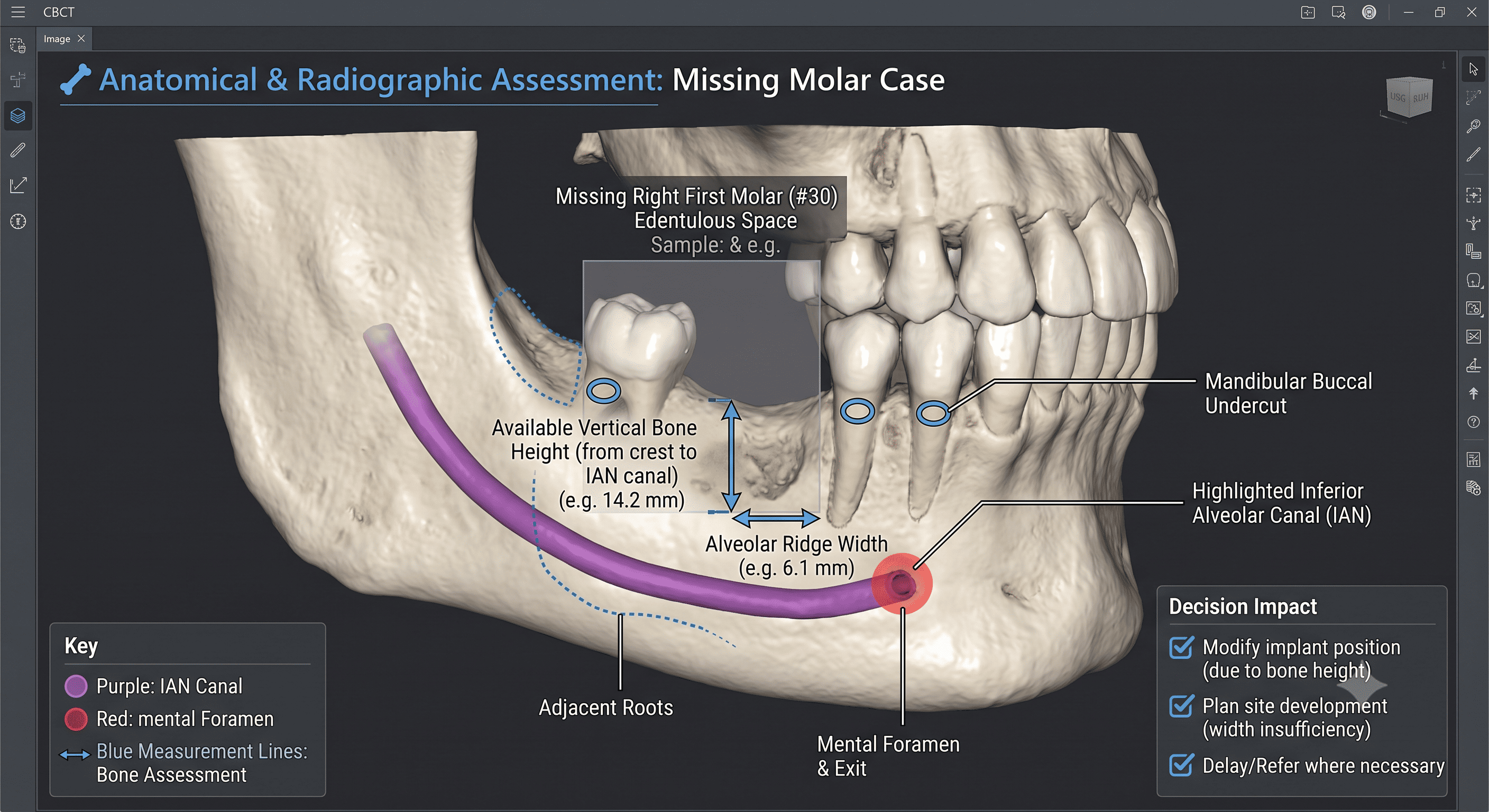 CBCT-derived 3D anatomical assessment of a missing right first molar site showing the available vertical bone height from the alveolar crest to the inferior alveolar canal, the alveolar ridge width, a highlighted inferior alveolar canal in purple, the mental foramen in red, an adjacent mandibular buccal undercut, and adjacent tooth roots. Demonstrates how CBCT anatomical findings such as bone height, ridge width, and proximity to the inferior alveolar canal change implant position, site development, and referral decisions.