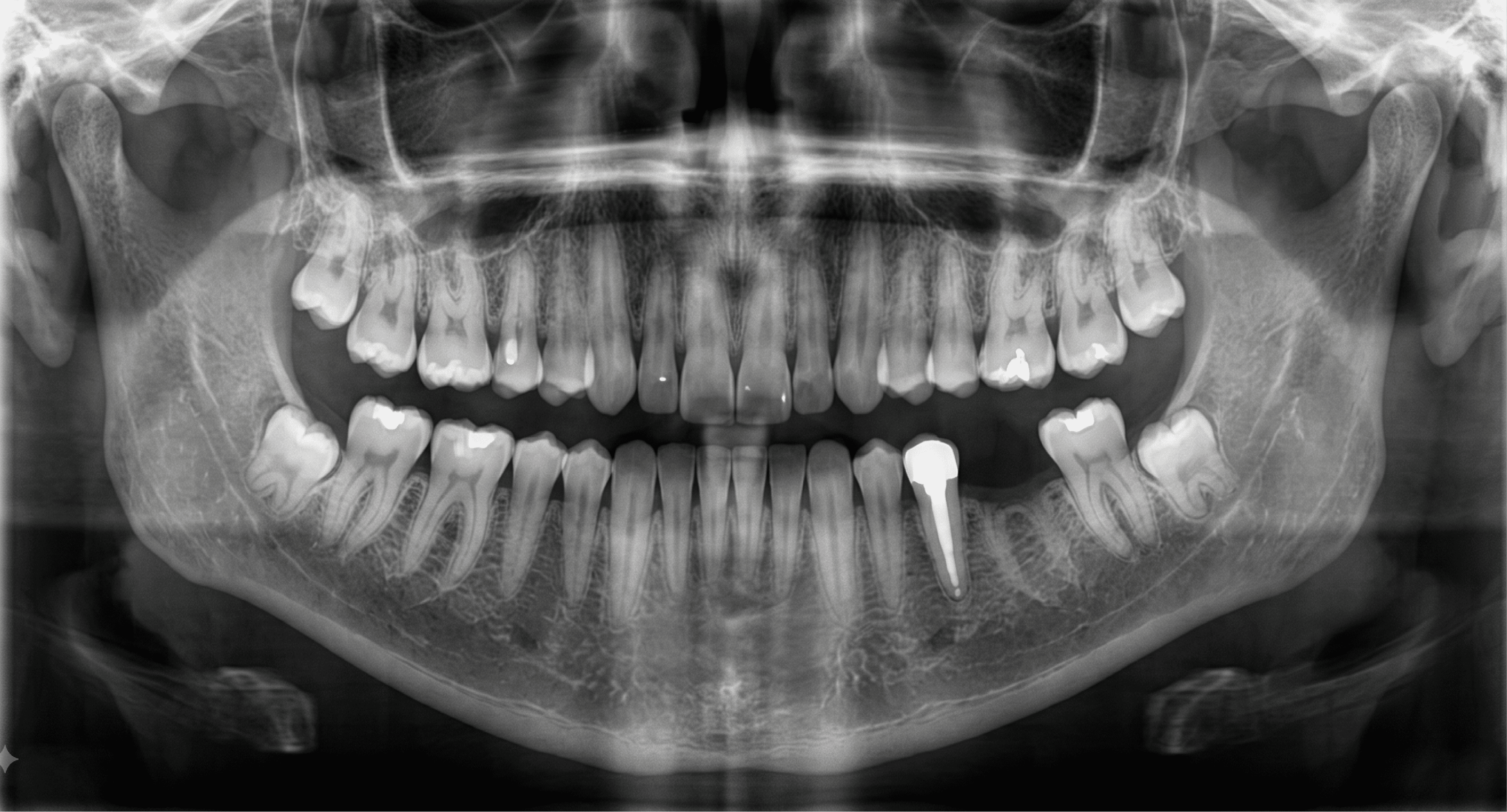 Full-mouth panoramic radiograph (OPG) showing a single dental implant fixture already integrated in the mandibular left first molar position, unerupted third molars visible in all four quadrants, and overall arch and root morphology. Demonstrates the role of a panoramic radiograph in global anatomical screening ahead of targeted CBCT assessment of a proposed implant site.