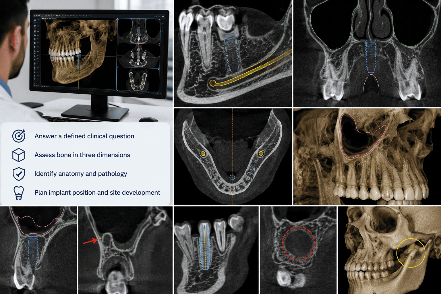 A dentist reviewing a 3D CBCT reconstruction and multiplanar views of an implant site on a workstation monitor, alongside a checklist for CBCT interpretation: answer a defined clinical question, assess bone in three dimensions, identify anatomy and pathology, and plan implant position and site development. Surrounding panels show CBCT cross-sections of implant sites near the inferior alveolar canal, maxillary sinus, and adjacent roots, plus a 3D skull reconstruction. Demonstrates the range of CBCT findings that influence implant surgical planning, site development, and referral decisions.