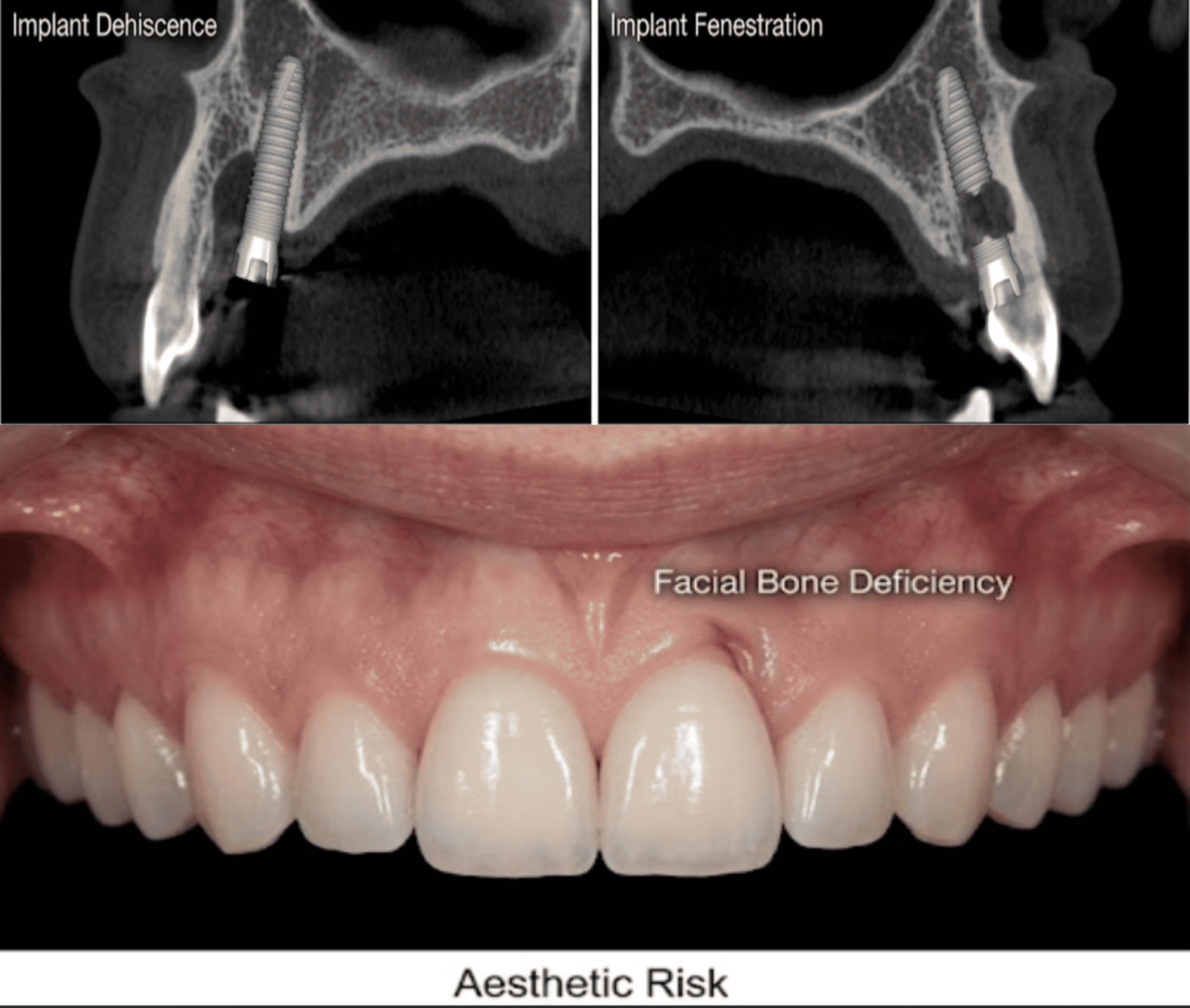 Side-by-side CBCT cross-sections labelled implant dehiscence, showing an implant with exposed buccal threads above the bone crest, and implant fenestration, showing an implant perforating the buccal plate mid-body, alongside an intraoral photograph of anterior facial bone deficiency and associated aesthetic risk. Demonstrates assessment of dehiscence and fenestration risk before implant placement.