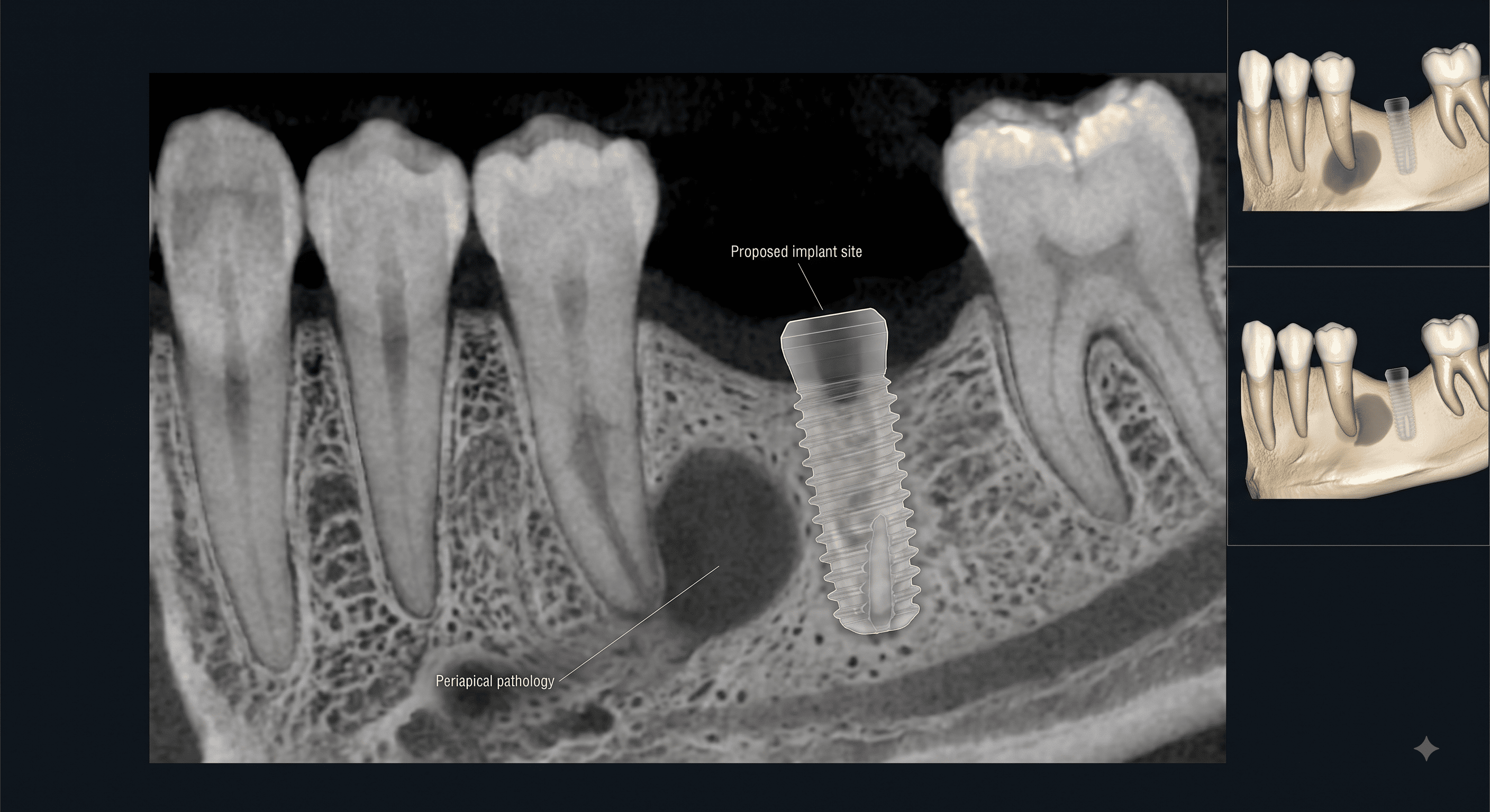 CBCT cross-sectional view labelled periapical pathology, showing a rounded radiolucent lesion at the apex of an adjacent tooth directly beside a proposed implant site, with 3D reconstruction insets comparing the lesion's proximity to the planned implant before and after treatment. Demonstrates identification of existing pathology that may require treatment before implant placement.