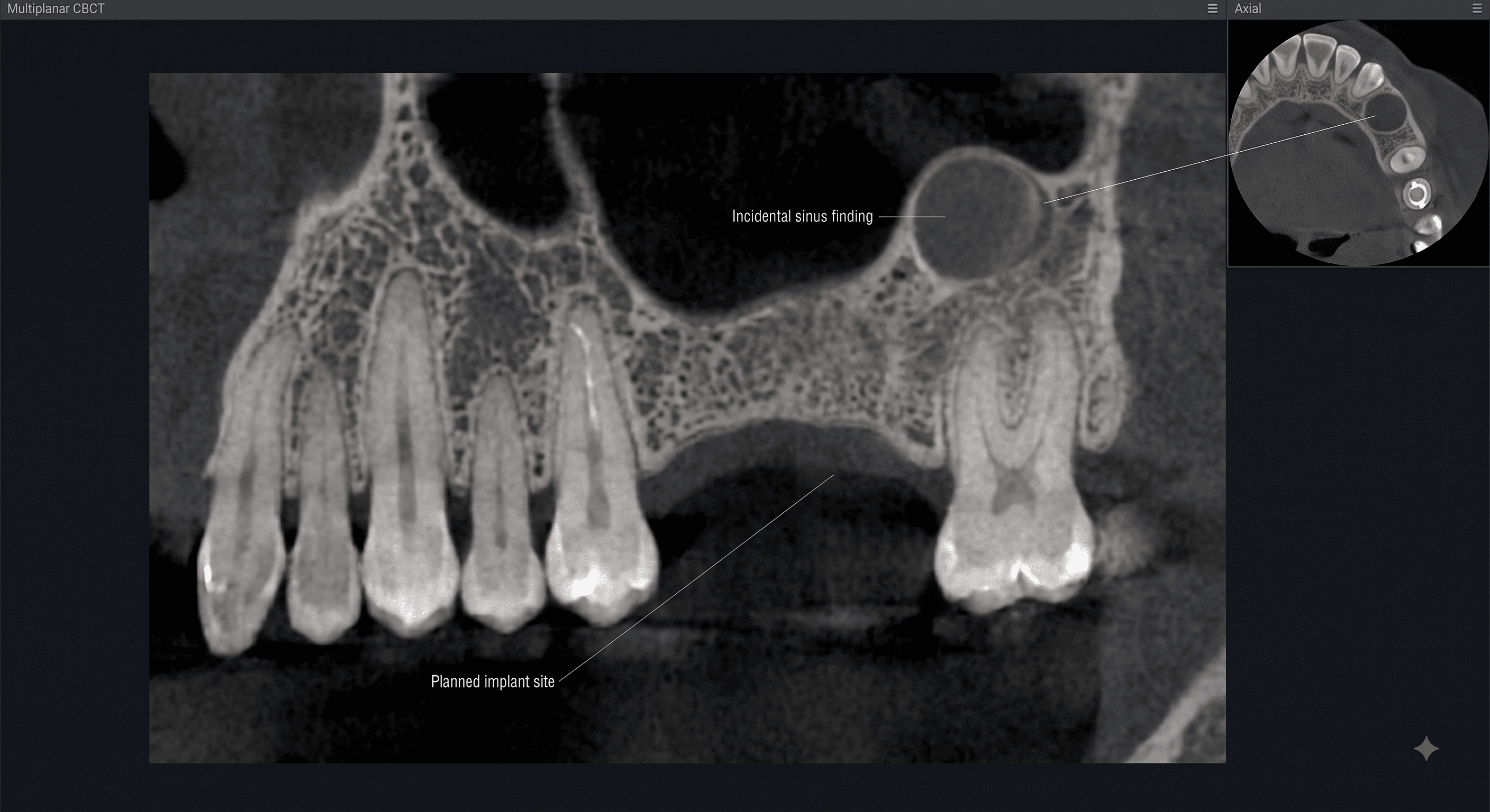 Multiplanar CBCT view labelled with a planned implant site in the posterior maxilla and, well away from it, an incidental sinus finding highlighted on both the coronal slice and an inset axial view. Demonstrates how CBCT may reveal incidental findings unrelated to the original implant planning question.