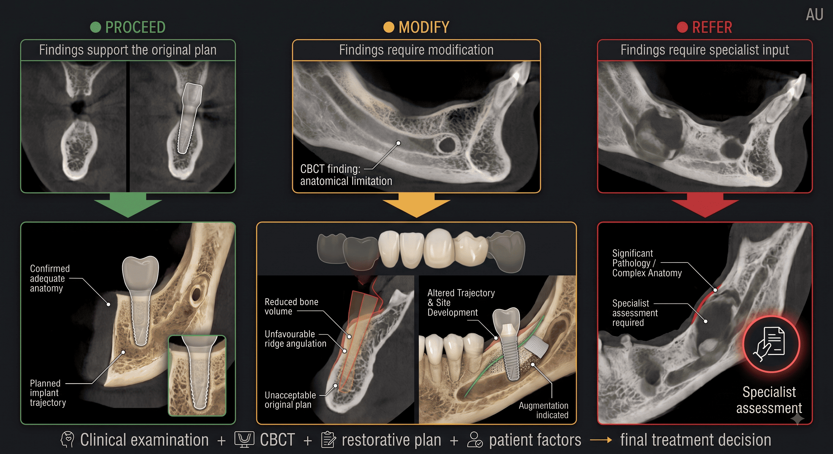 Three-column clinical decision flowchart: PROCEED, where findings support the original plan with confirmed adequate anatomy and the planned implant trajectory; MODIFY, where a CBCT finding of anatomical limitation such as reduced bone volume or unfavourable ridge angulation makes the original plan unacceptable and leads to an altered trajectory, site development, and augmentation; and REFER, where significant pathology or complex anatomy requires specialist assessment. Each pathway combines clinical examination, CBCT, the restorative plan, and patient factors into the final treatment decision.