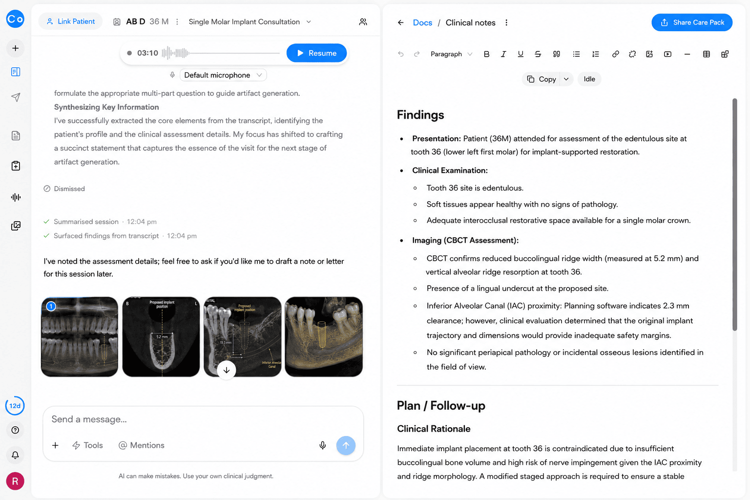 CoTreat Chairside clinical note interface showing an AI-generated Findings document for a single molar implant consultation at tooth 36, recording CBCT-confirmed reduced buccolingual ridge width (5.2 mm), vertical ridge resorption, a lingual undercut, and inferior alveolar canal clearance of 2.3 mm judged an inadequate safety margin for the original implant trajectory, with no periapical pathology or incidental findings. Demonstrates AI-assisted structured clinical documentation of CBCT findings for implant treatment planning.