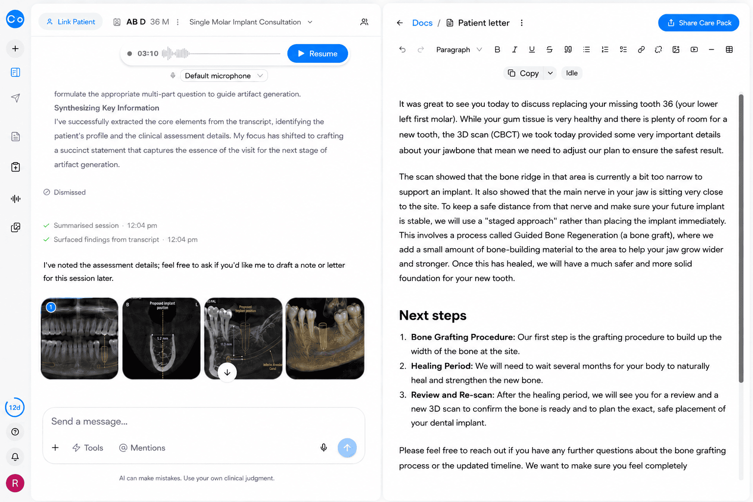 CoTreat Chairside patient letter editor showing an AI-generated letter for an implant consultation explaining, in plain language, why the CBCT scan of the missing lower left first molar site showed a bone ridge that is too narrow and a nerve positioned close to the site, requiring a staged approach of bone grafting, a healing period, and a new scan before implant placement. Demonstrates AI-assisted patient communication translating CBCT findings into understandable language.