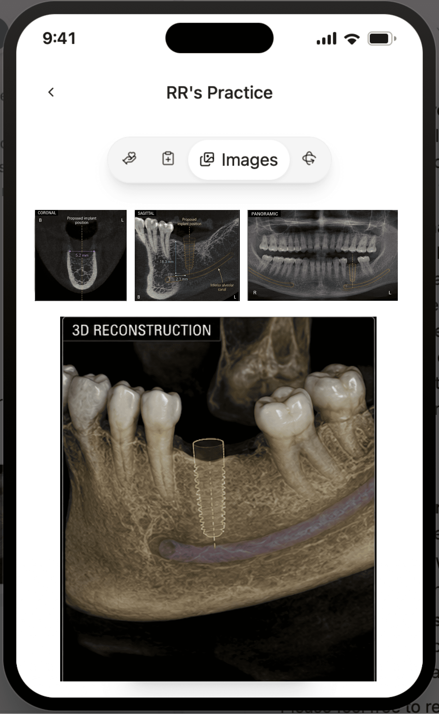 CoTreat Patient Care Pack mobile interface Images tab showing the patient's own CBCT coronal, sagittal, and panoramic views alongside a 3D reconstruction with the inferior alveolar canal highlighted in purple beneath the proposed implant position. Demonstrates giving patients direct, understandable access to their own CBCT imaging alongside the consultation letter.
