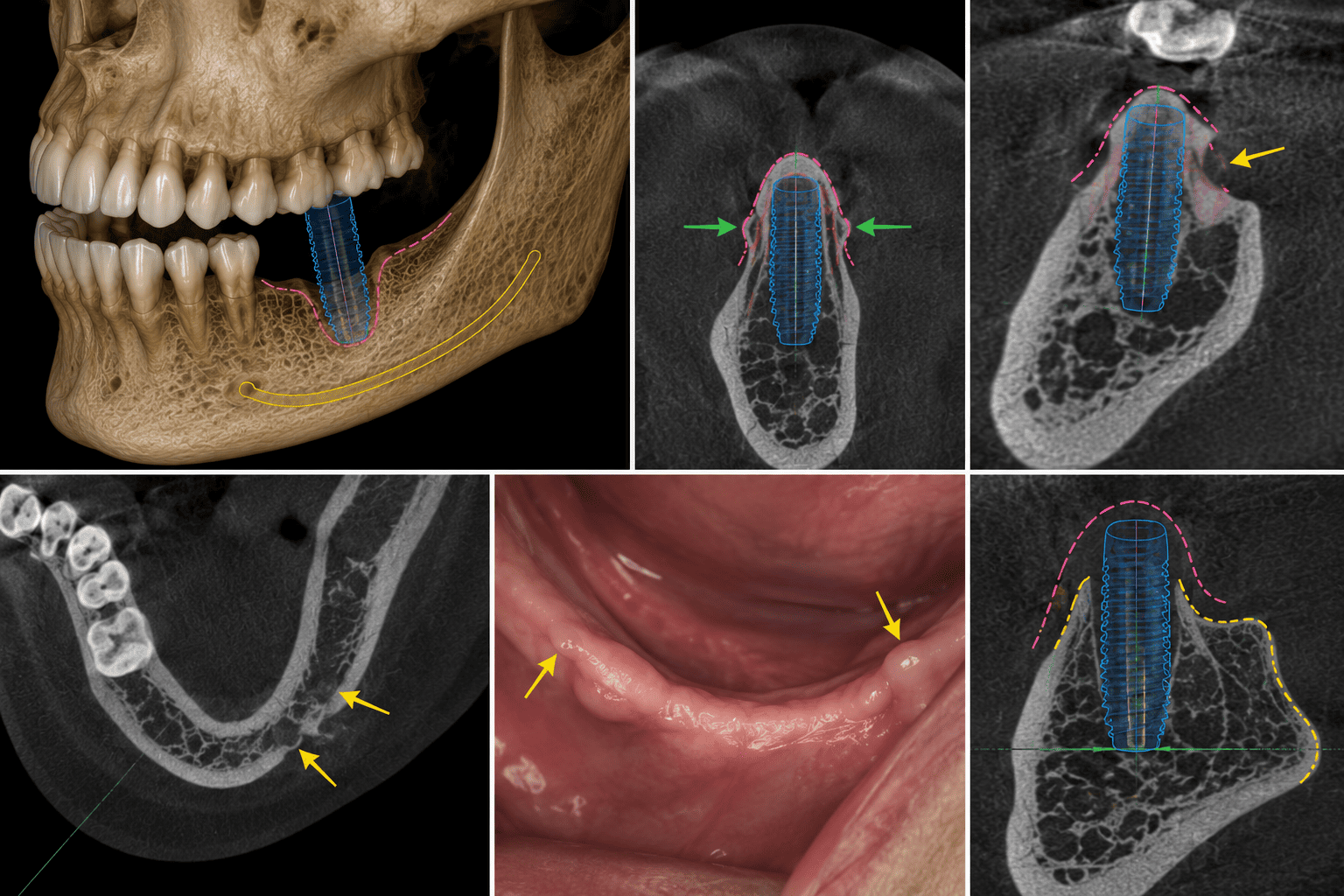 3D CBCT reconstruction and cross-sectional views of a mandibular implant showing a buccal ridge concavity and thin buccal plate outlined around the implant, with green arrows marking the narrowest points and an intraoral photograph showing corresponding mucosal thinning over the site. Demonstrates how ridge morphology and undercuts are assessed for their effect on implant angulation and buccal plate integrity.