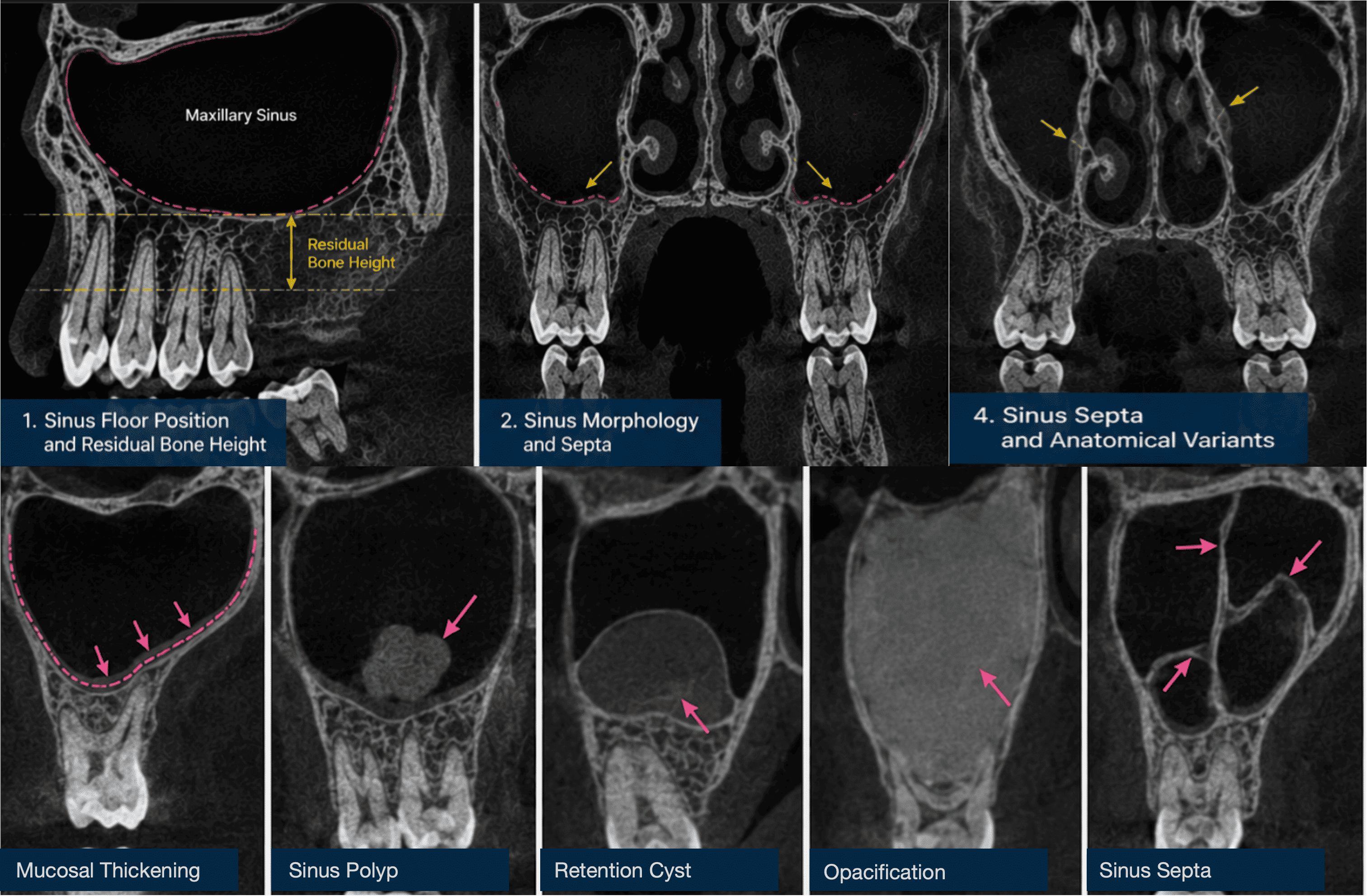 Labelled CBCT coronal views of the maxillary sinus showing sinus floor position and residual bone height, sinus morphology and septa, and anatomical variants, alongside close-up panels illustrating mucosal thickening, a sinus polyp, a retention cyst, opacification, and sinus septa. Demonstrates assessment of sinus floor position, residual bone height, and sinus pathology before posterior maxillary implant planning.