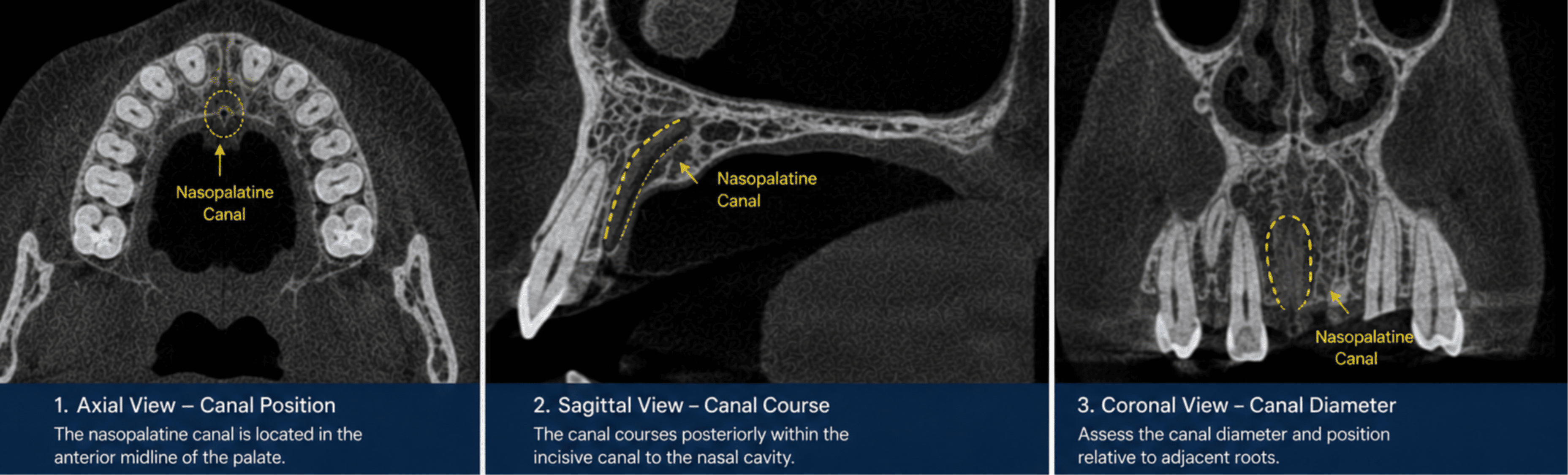 Labelled axial, sagittal, and coronal CBCT views of the anterior maxilla showing the nasopalatine canal in the midline of the palate, its posterior course through the incisive canal toward the nasal cavity, and its diameter relative to adjacent roots. Demonstrates assessment of nasopalatine canal position and risk of encroachment during anterior maxillary implant planning.