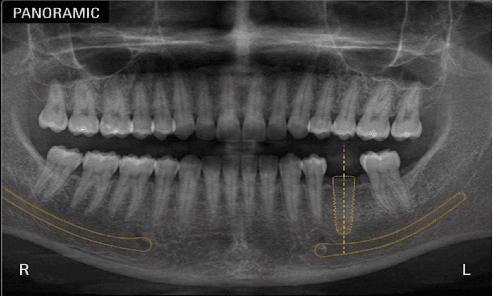 Panoramic radiograph (OPG) showing the full mandibular and maxillary arches, used for initial anatomical screening, including the outlined mandibular canal and a planned implant position at a lower left molar site ahead of targeted CBCT assessment. Demonstrates the role of a panoramic radiograph in global anatomical screening before three-dimensional bone assessment.