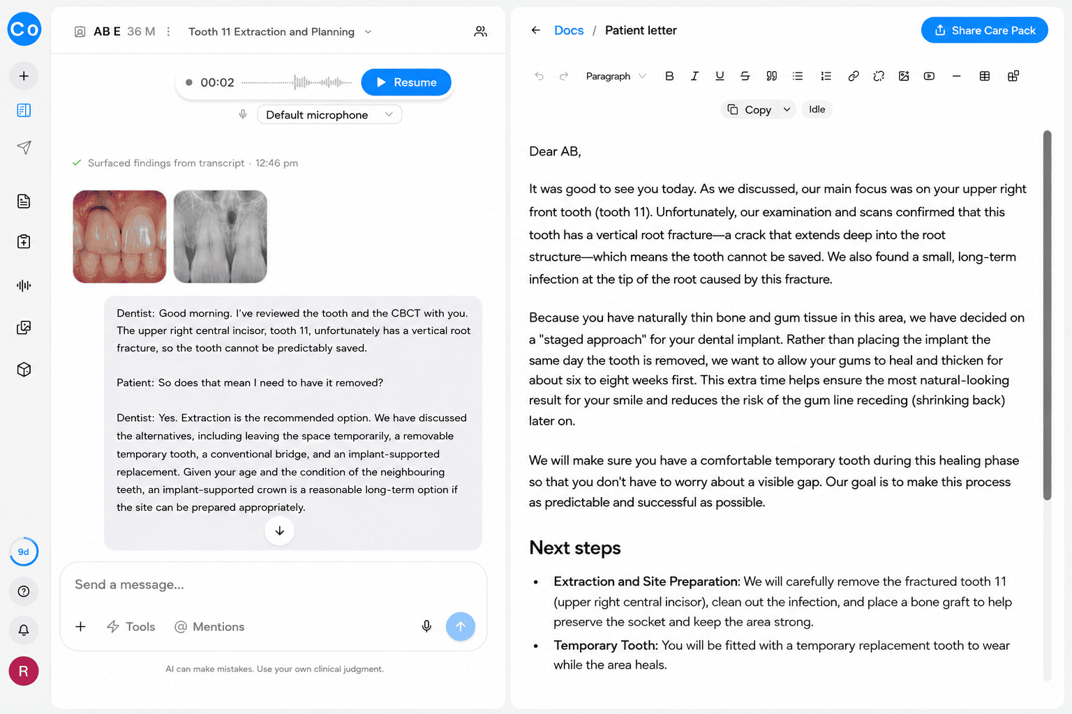 CoTreat Chairside patient letter editor showing an AI-generated letter to a patient explaining, in plain language, that their upper right front tooth has a vertical root fracture and cannot be saved, and that because they have naturally thin bone and gum tissue, a staged approach is recommended: extraction with a bone graft now, six to eight weeks of healing with a temporary tooth, then the dental implant. Demonstrates AI-assisted patient communication translating a timing decision into understandable language.