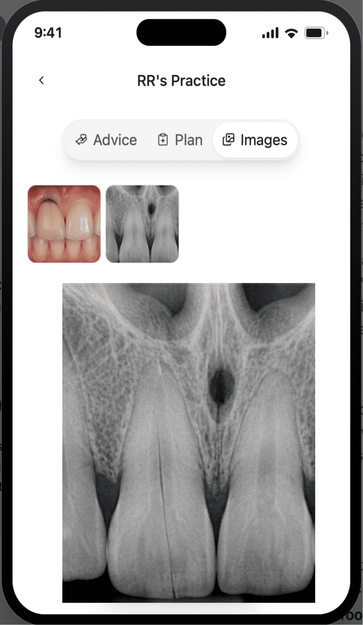 CoTreat Patient Care Pack mobile interface Images tab showing the patient's own clinical photograph and periapical radiograph of the fractured tooth, including an enlarged radiograph view. Demonstrates giving patients direct, understandable access to their own imaging alongside the consultation letter.