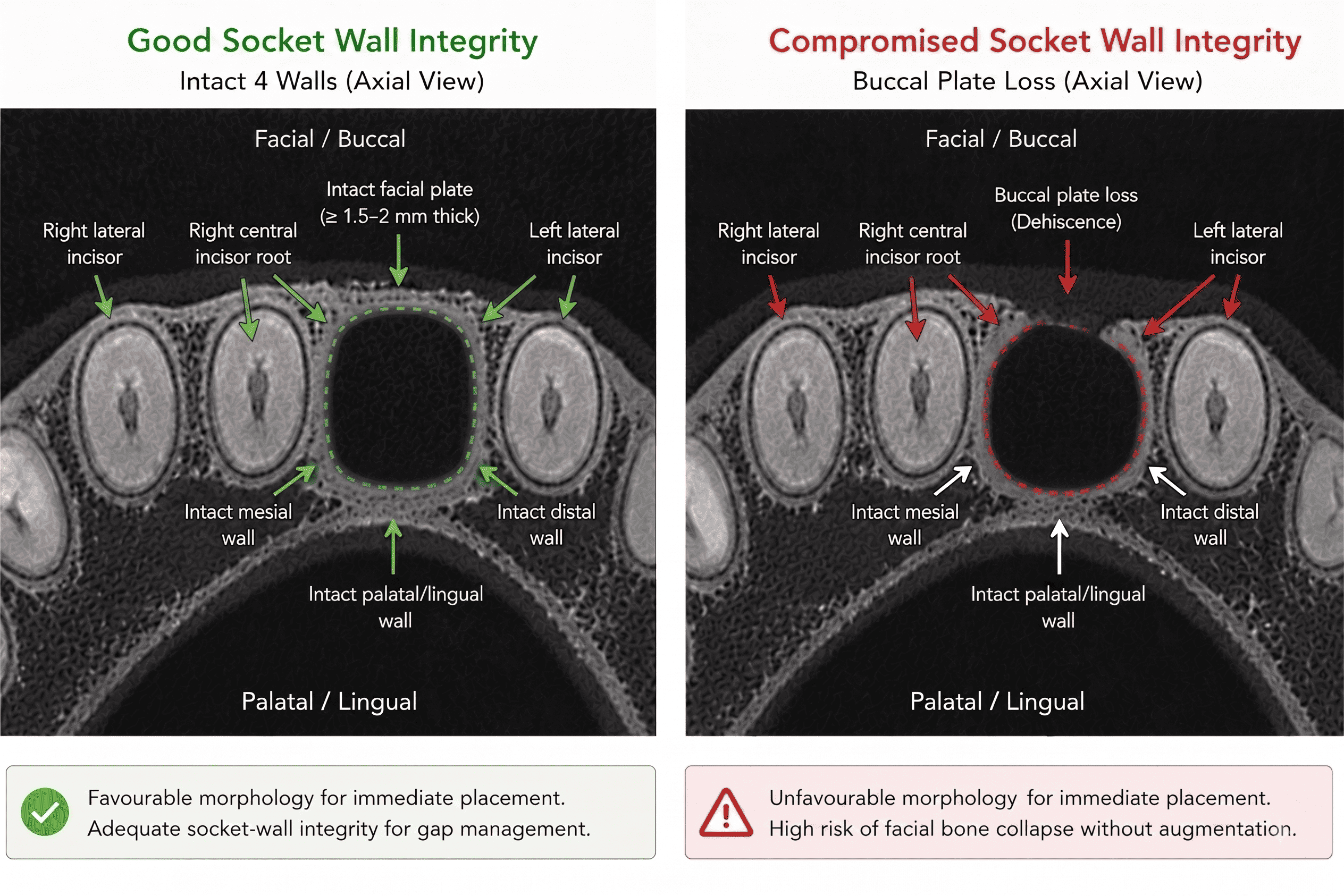 Side-by-side axial CBCT comparison labelled Good Socket Wall Integrity, showing an intact facial plate at least 1.5 to 2mm thick with intact mesial, distal, and palatal/lingual walls, versus Compromised Socket Wall Integrity, showing buccal plate loss (dehiscence) with the other three walls still intact. Demonstrates how socket-wall morphology determines favourability for immediate implant placement.