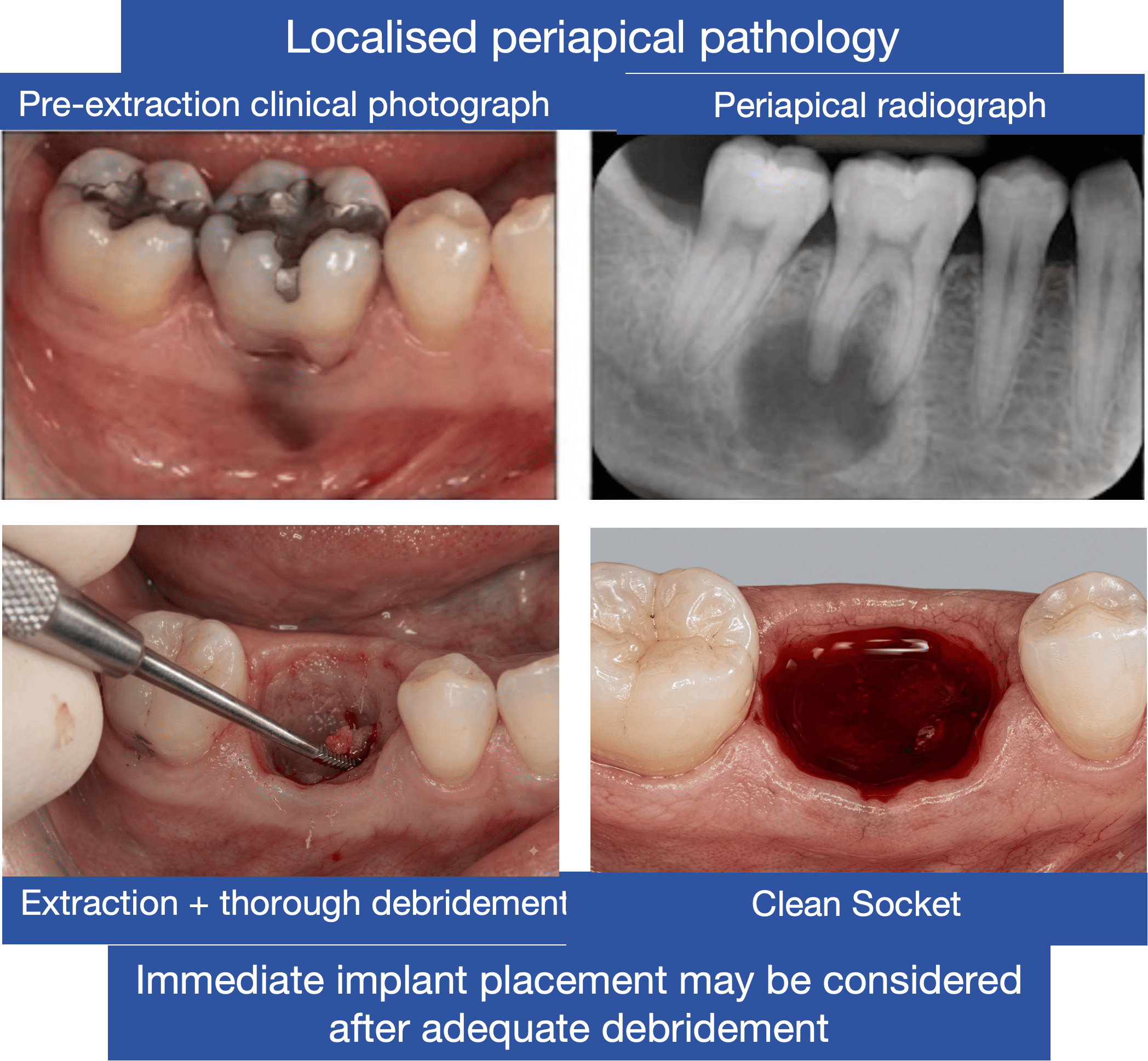 Four-panel clinical case labelled Localised Periapical Pathology, showing a pre-extraction clinical photograph, a periapical radiograph, extraction with thorough debridement, and the resulting clean socket. Demonstrates that chronic, localised periapical pathology may still permit immediate implant placement after adequate debridement.