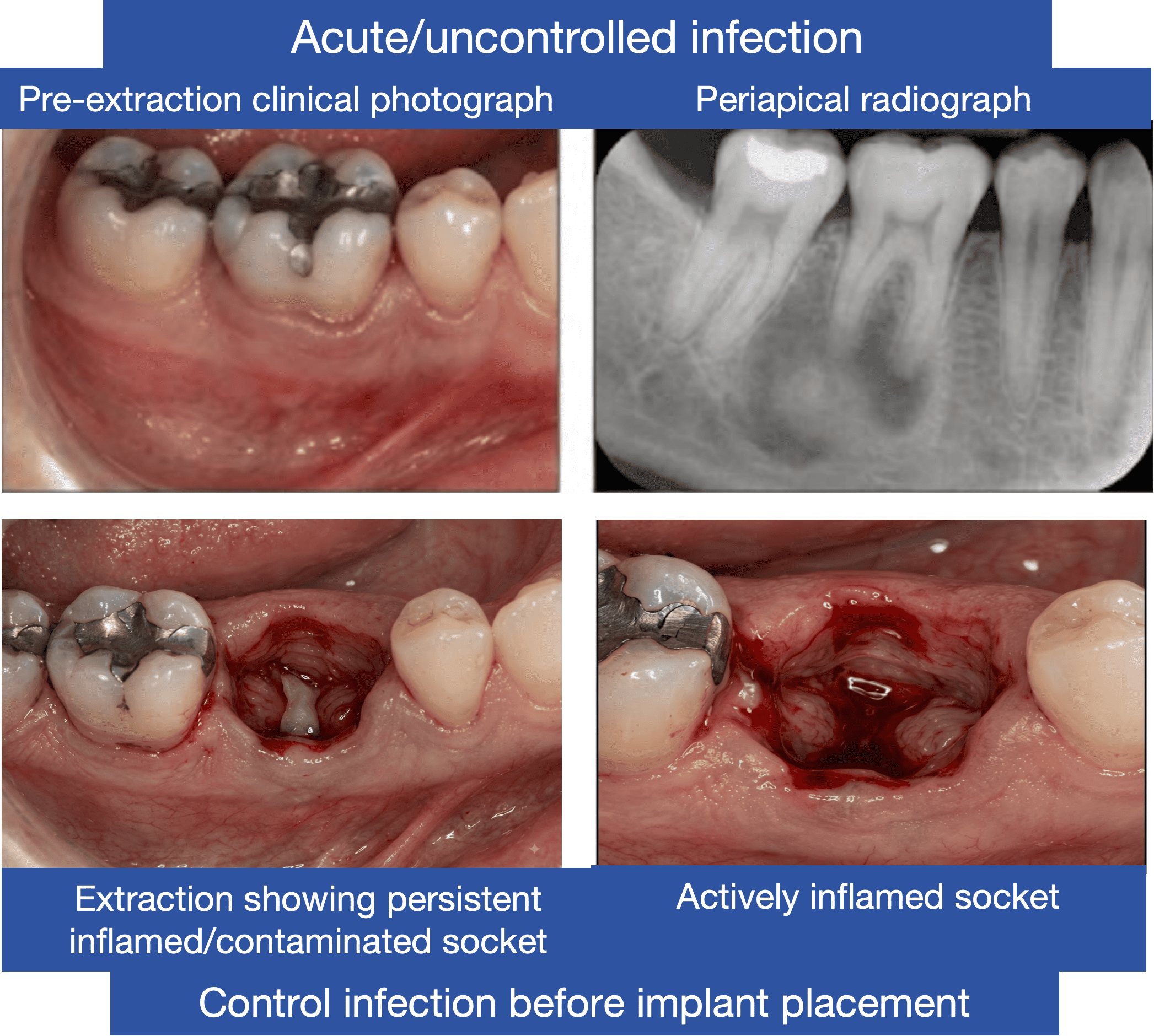 Four-panel clinical case labelled Acute/Uncontrolled Infection, showing a pre-extraction clinical photograph, a periapical radiograph, extraction showing a persistent inflamed and contaminated socket, and an actively inflamed socket after extraction. Demonstrates that acute or uncontrolled infection should be controlled before implant placement.