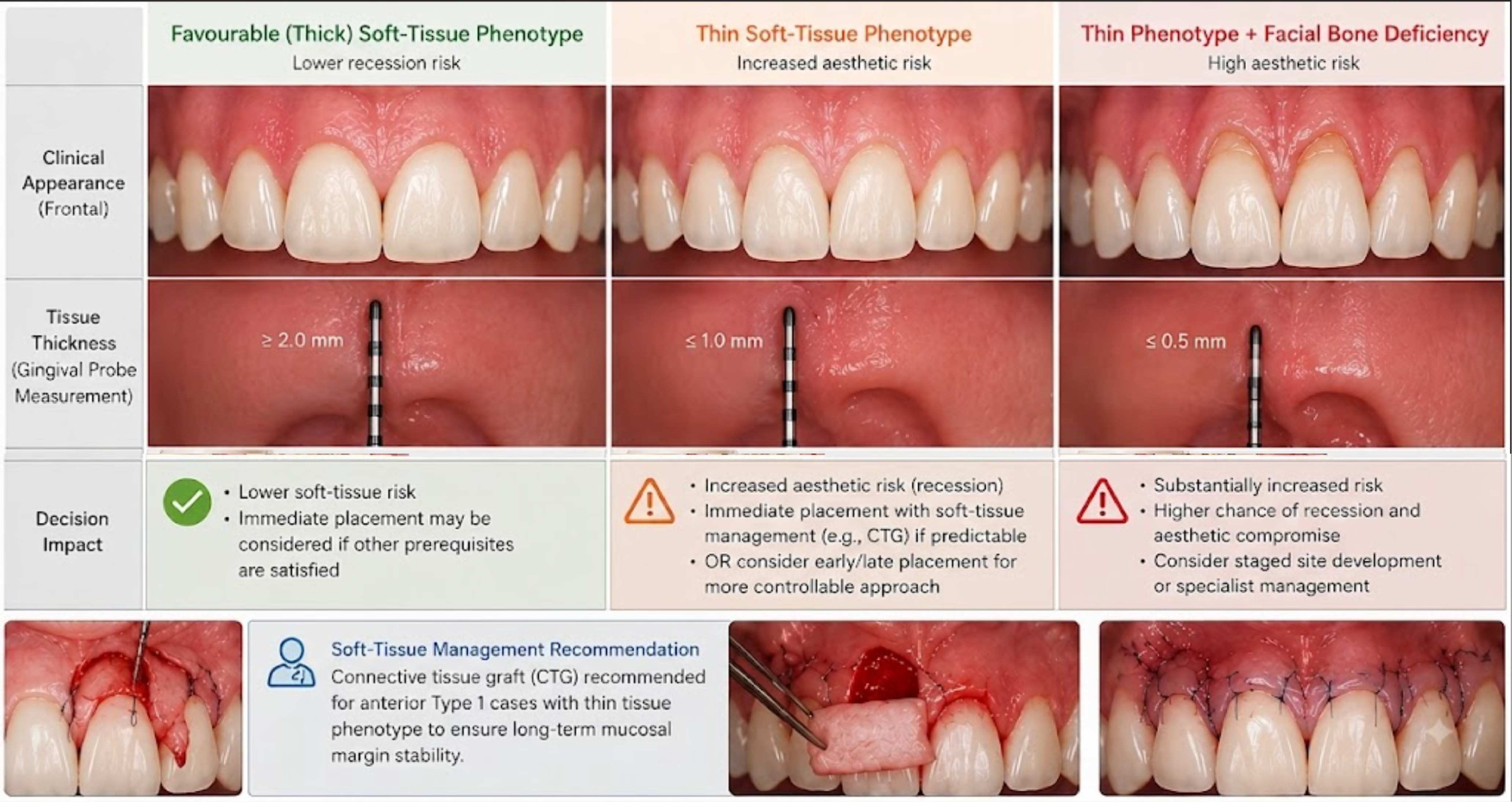 Three-column comparison of favourable thick soft-tissue phenotype (tissue thickness at least 2.0mm, lower recession risk), thin soft-tissue phenotype (1.0mm or less, increased aesthetic risk), and thin phenotype with facial bone deficiency (0.5mm or less, high aesthetic risk), each with a clinical photograph and gingival probe measurement, alongside connective tissue graft (CTG) surgical steps. Demonstrates how measured tissue thickness changes the implant timing and soft-tissue management decision.
