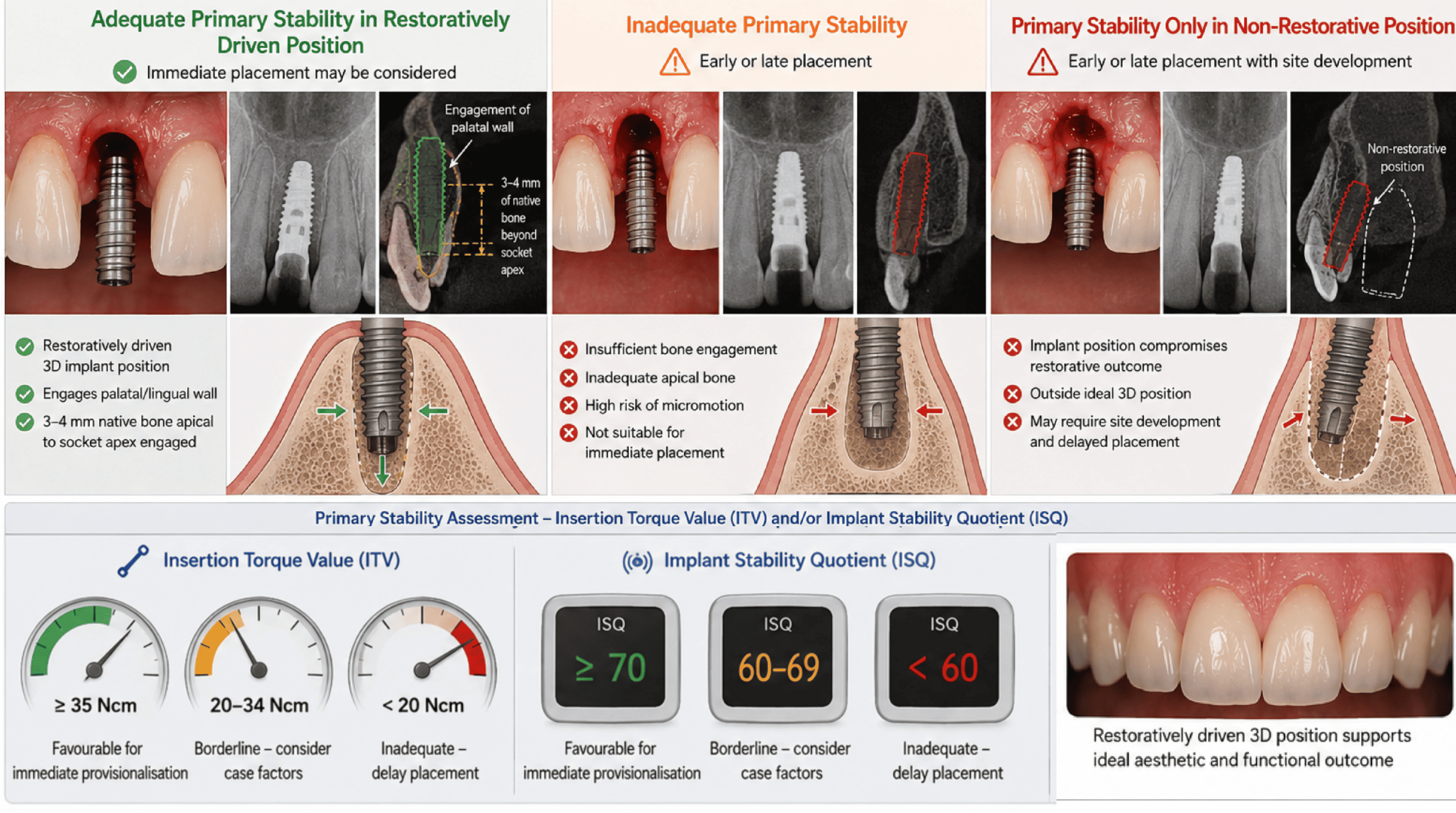 Three-column comparison of adequate primary stability in a restoratively driven position (engaging the palatal wall and 3 to 4mm of native bone apical to the socket), inadequate primary stability with insufficient bone engagement, and stability achieved only in a non-restorative position, alongside insertion torque value (ITV) and implant stability quotient (ISQ) gauges showing favourable, borderline, and inadequate ranges. Demonstrates how primary stability and implant position together determine whether immediate placement or provisionalisation is appropriate.