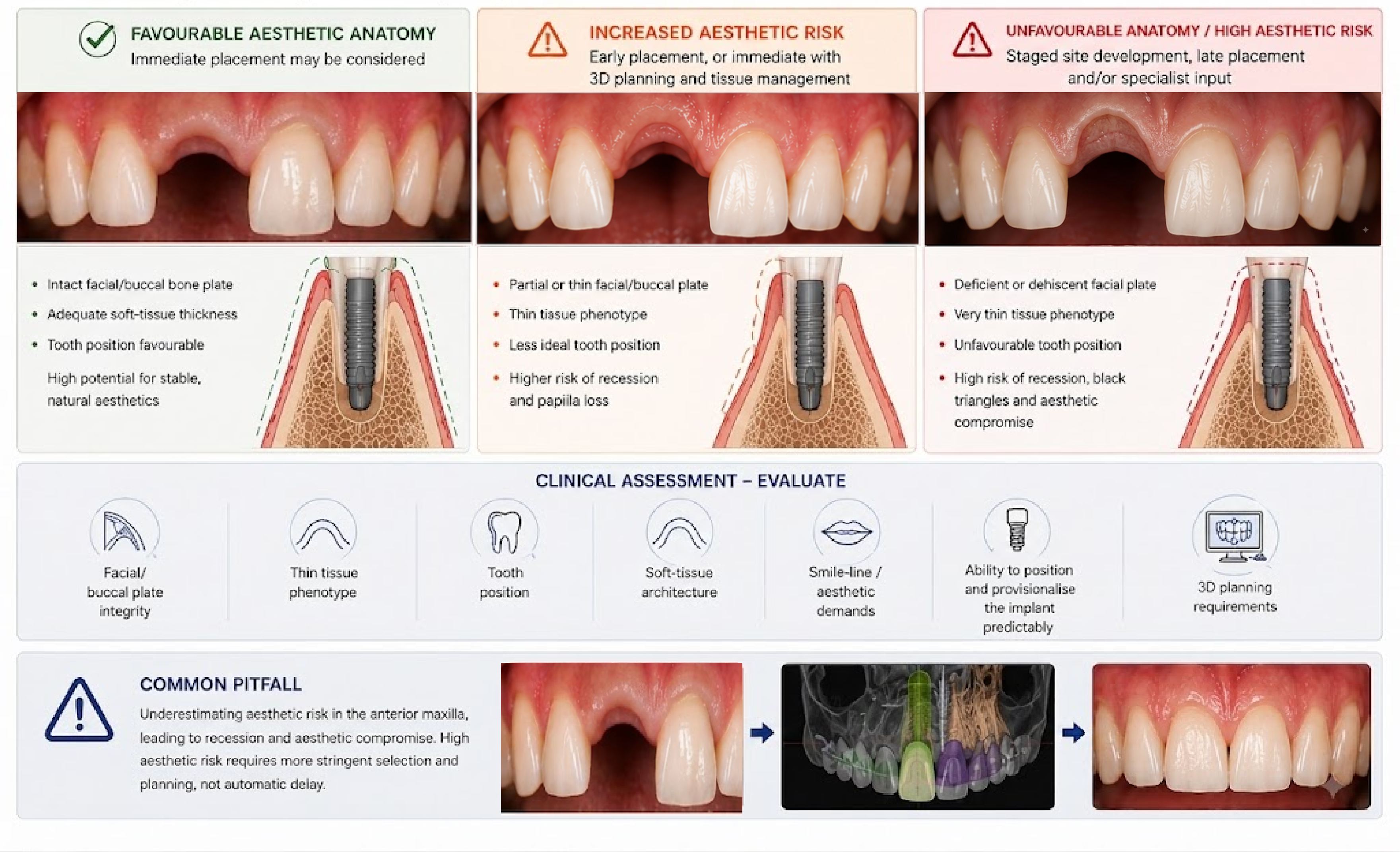 Three-column comparison of favourable aesthetic anatomy (intact facial/buccal bone plate, adequate soft-tissue thickness, favourable tooth position), increased aesthetic risk (partial or thin facial/buccal plate, thin tissue phenotype), and unfavourable anatomy with high aesthetic risk (deficient or dehiscent facial plate, very thin tissue phenotype), each with a clinical photograph and cross-sectional implant diagram, alongside a case sequence from gap to 3D-planned implant to final restoration. Demonstrates how aesthetic-zone risk factors change the timing and planning approach.