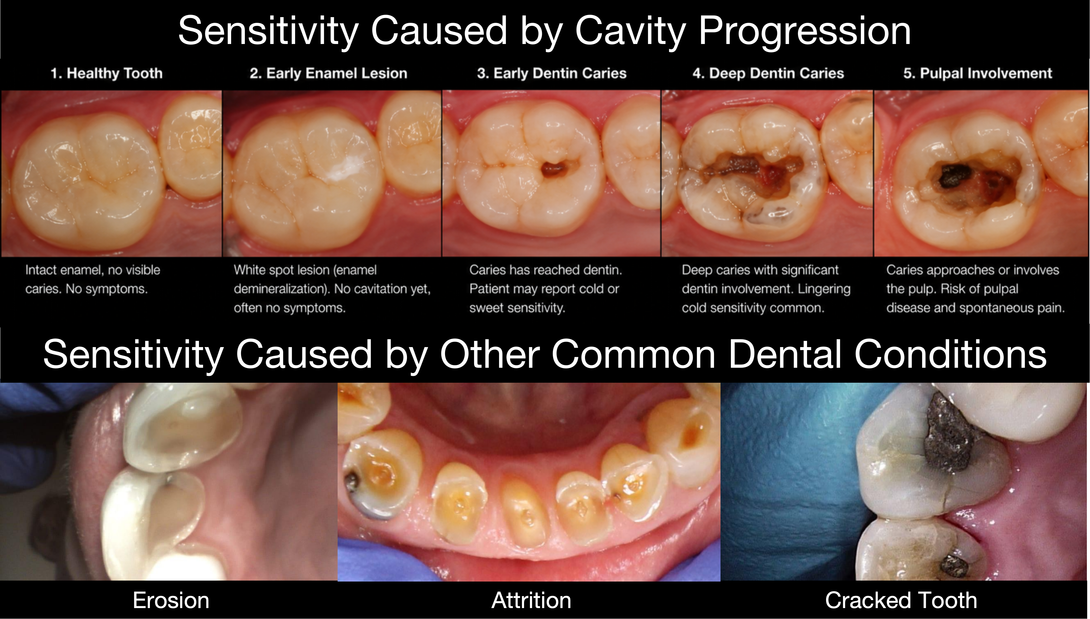 Tooth sensitivity is a symptom, not a diagnosis — it may signal early decay, a progressing cavity, worn enamel, erosion, a cracked tooth, or another dental condition.