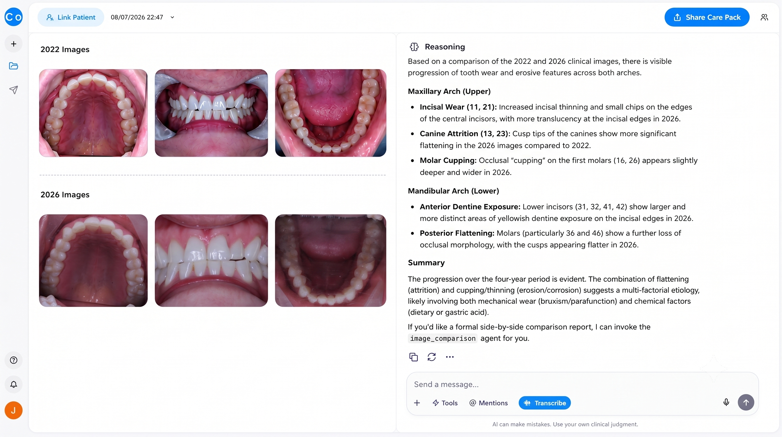CoTreat comparing 2022 and 2026 clinical images of the same patient, with AI reasoning identifying progressive incisal wear, canine attrition, molar cupping and dentine exposure across the four-year span