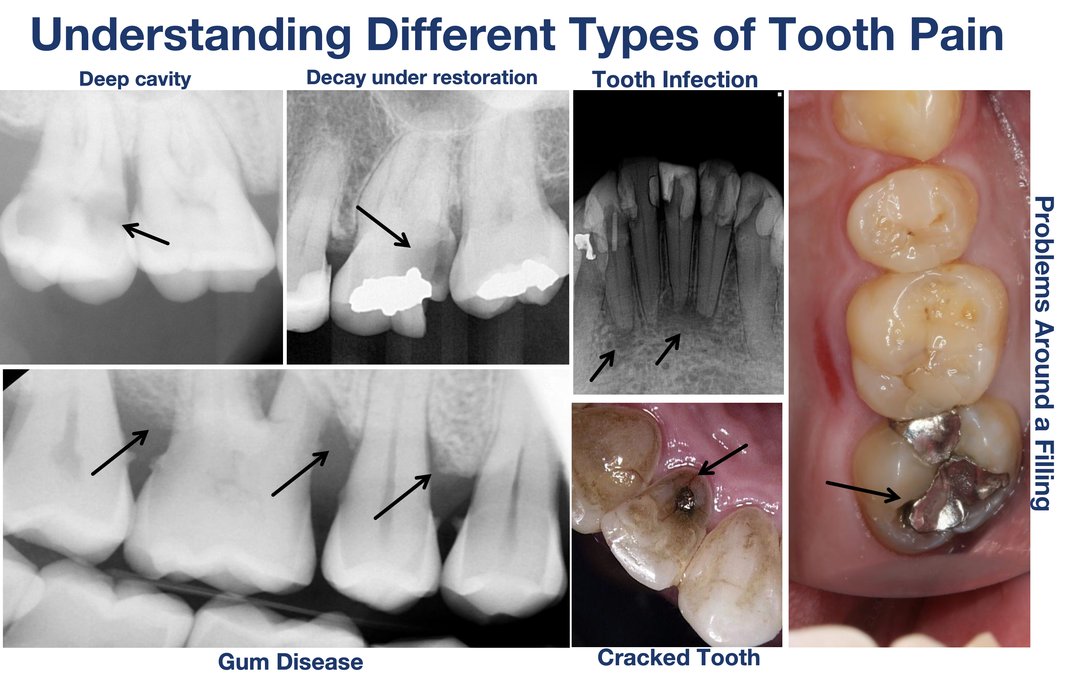 Six dental X-rays and clinical photos showing different causes of tooth pain: a deep cavity, decay under a restoration, a tooth infection, problems around a filling, gum disease, and a cracked tooth.
