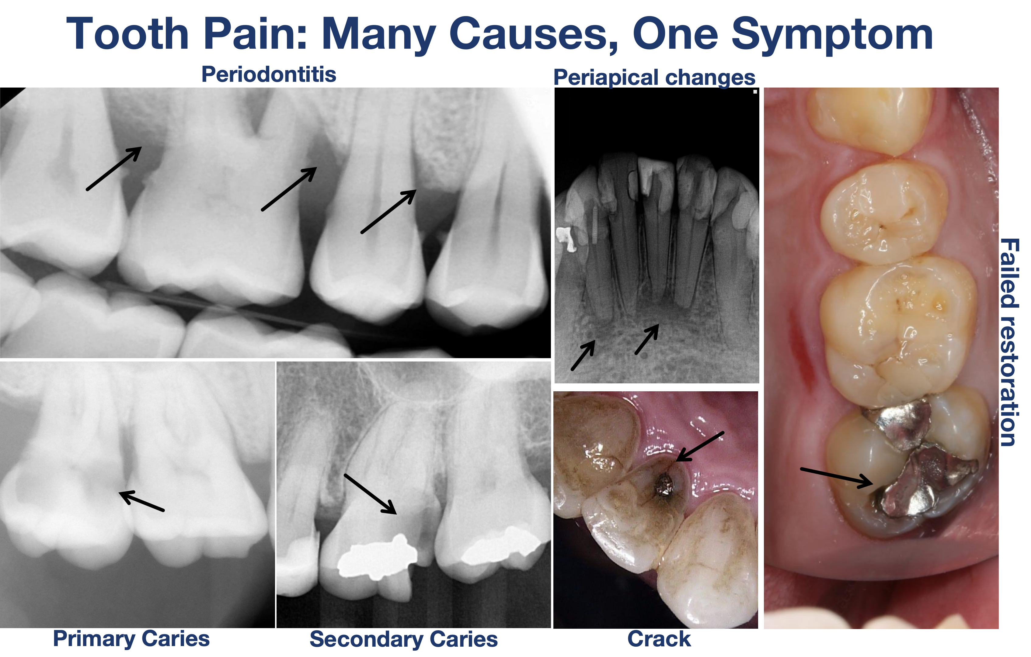 Composite of periapical radiographs and clinical photographs showing different causes of tooth pain, including periodontitis, periapical changes, primary caries, secondary caries, a cracked tooth, and a failed restoration.